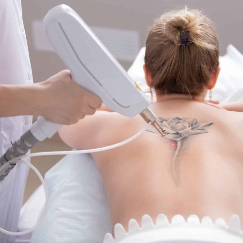 pusimeigi-ja-tatoveeringute-eemaldus-koolitus-laseri-abil